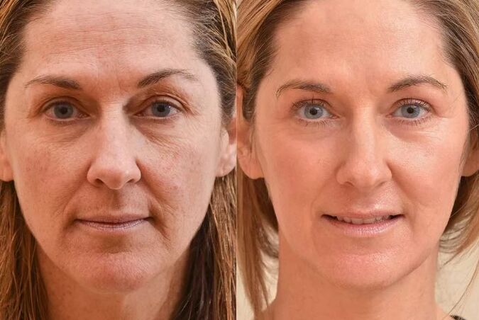 Face before and after face