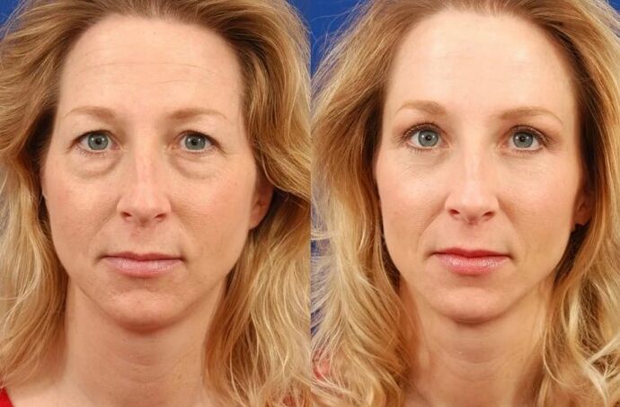 Rejuvenate on the spot