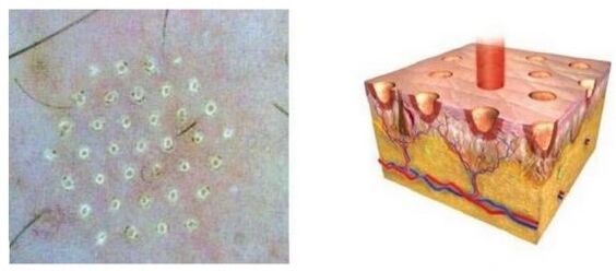 Fraction laser affects skin points