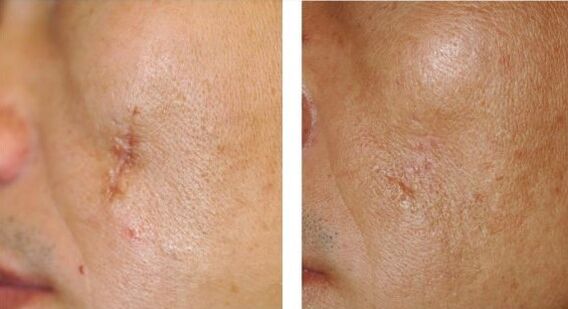 Laser results