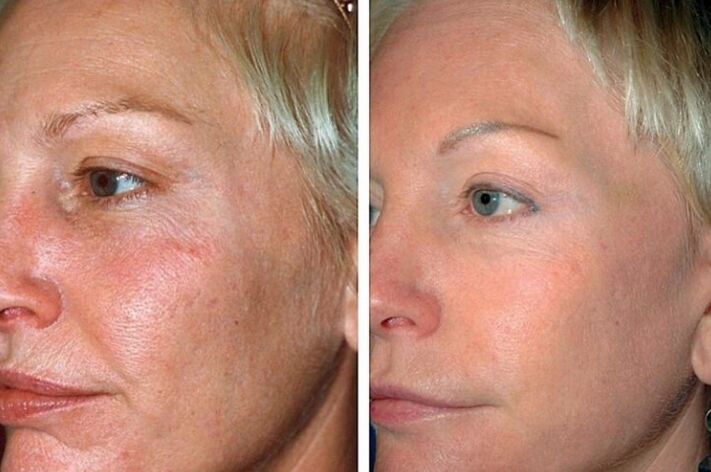 Before and after recovery program
