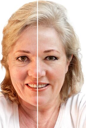 Rejuvenation of the face