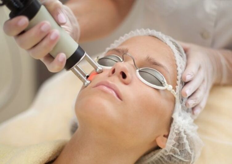On-site laser recovery program