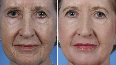 Before and after photos of partial facial rejuvenation surgery