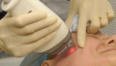 How is fractional skin rejuvenation performed