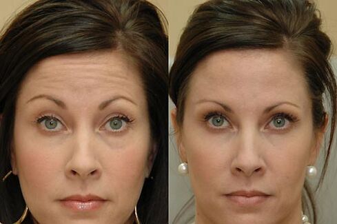 Botulinum toxin injections can be used anywhere on the face