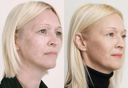 Fruit acid medium peeling