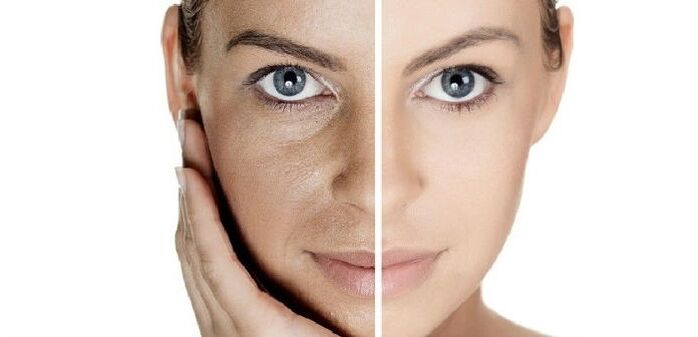 Facial skin rejuvenation before and after