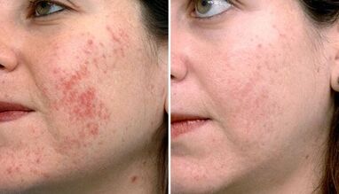 Before and after photos of fractional skin rejuvenation