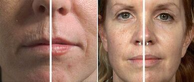 Fractional skin rejuvenation before and after