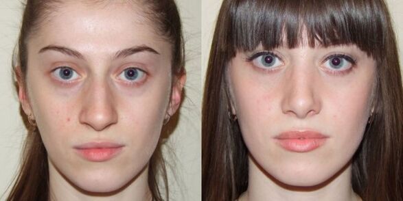 Girl before and after plasma facial rejuvenation