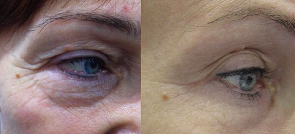 Results of effective plasma rejuvenation of the area around the eyes