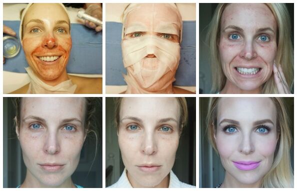 Stages of facial skin healing after successful plasma lift