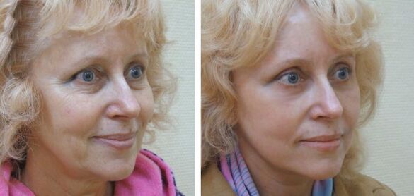 Woman before and after plasma facial rejuvenation